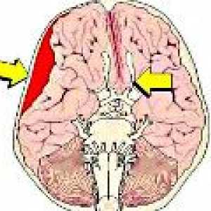 Možganska stiskanje