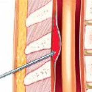 Spinal epiduralna krvavitev