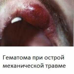 Stomatitis (vnetje ustne votline) s slikami
