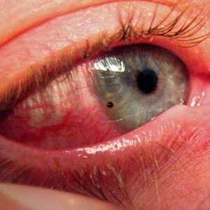 Poškodbe oči