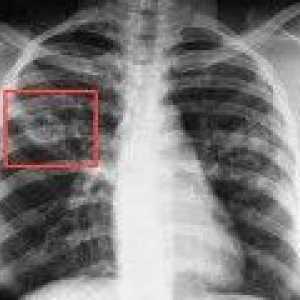Pulmonalne tuberkuloze