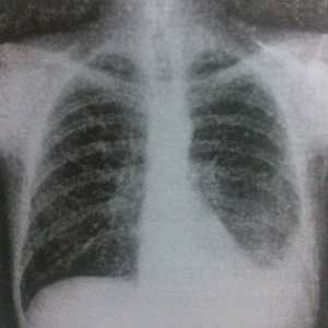 Tuberkulozne plevritis