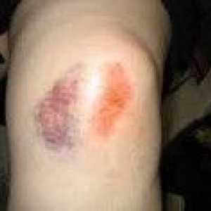 Poškodba kolena