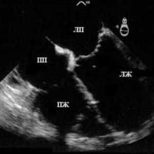 Ultrazvok srca (ehokardiografija)