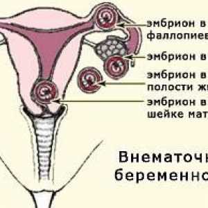 Zunajmaternične nosečnosti