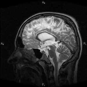 Notranja hidrocefalus možgani