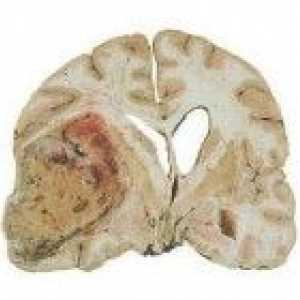 Intracerebralne tumorji možganskih polobel
