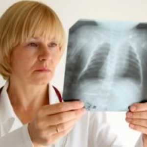 WHO opozarja na vrnitev tuberkuloze