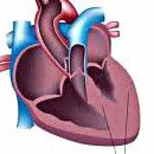 Sekundarni kardiomiopatija