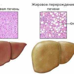 Maščobno degeneracije jeter